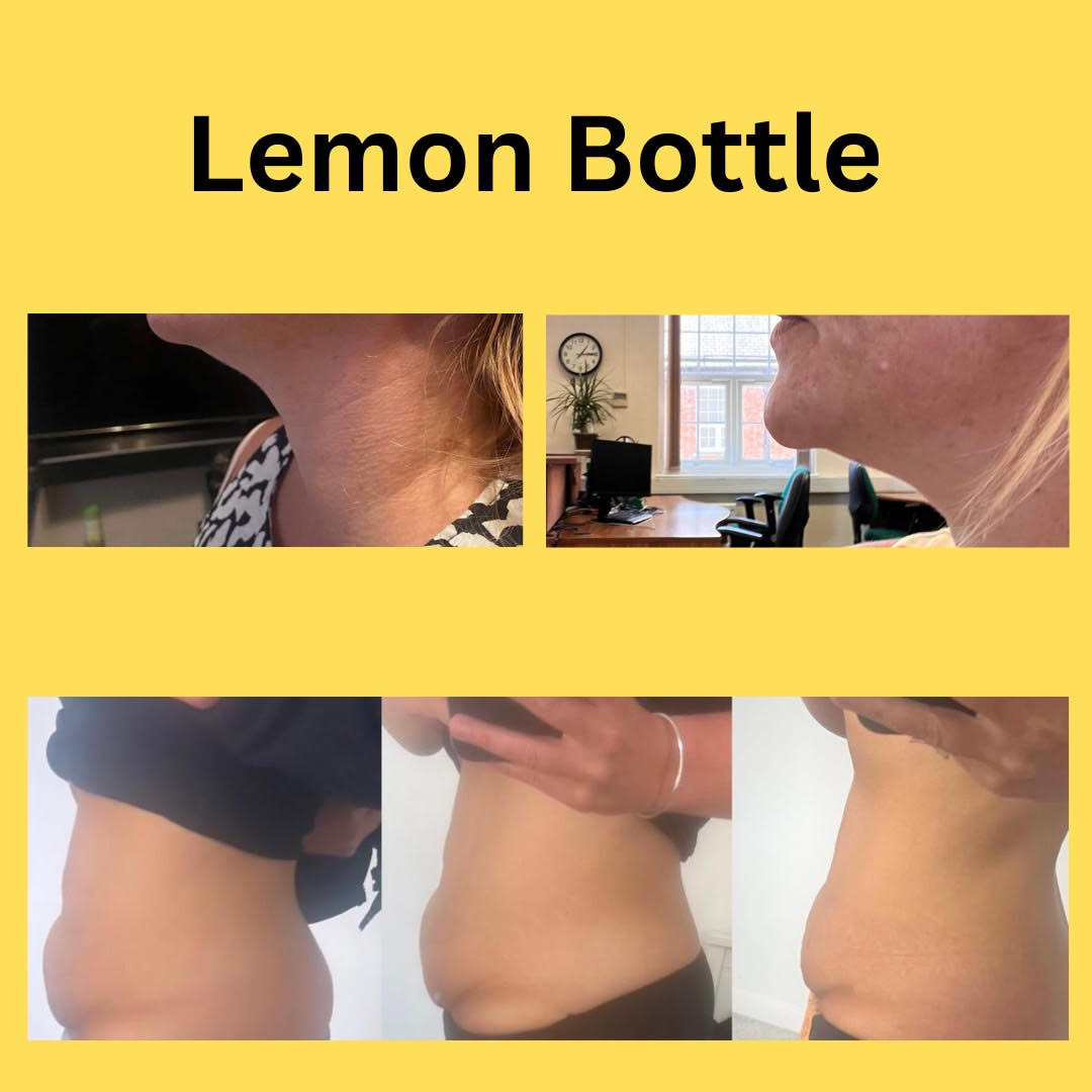 30+ Lemon Bottle Fat Dissolving Side Effects